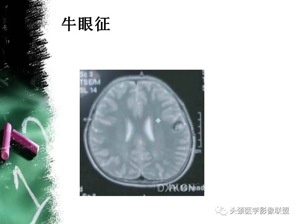 影像PPT - 【PPT】影像异常征象—神经科常见影像征象-15