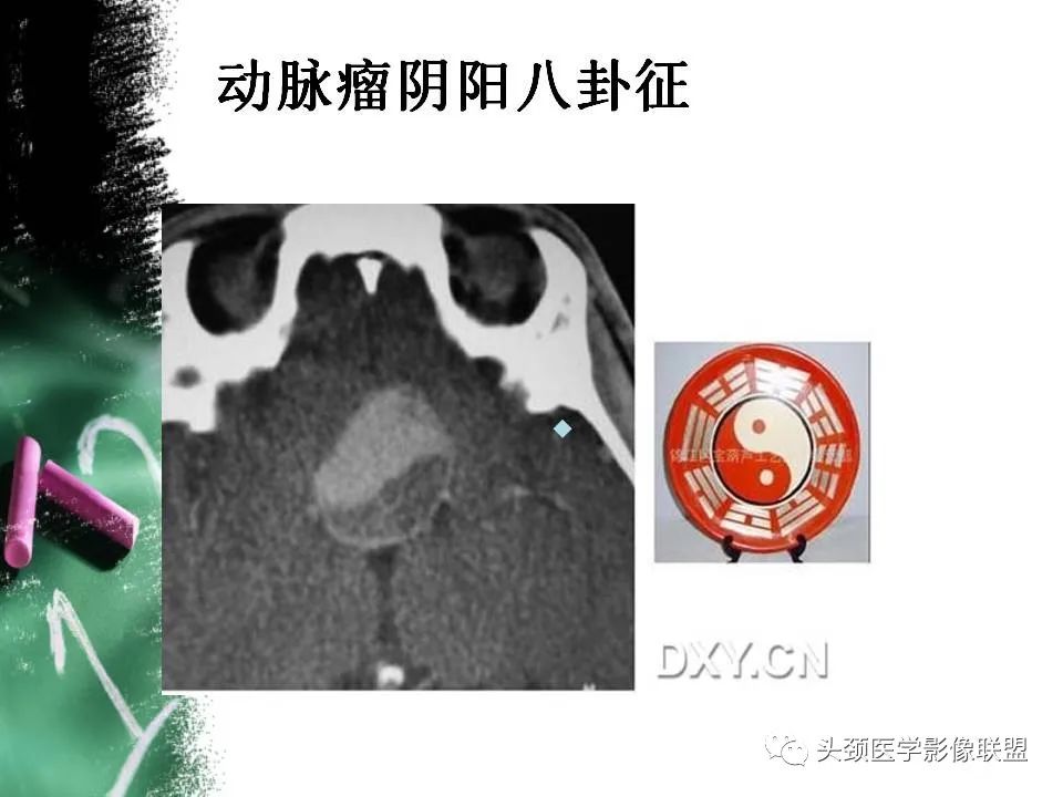 影像PPT - 【PPT】影像异常征象—神经科常见影像征象-16