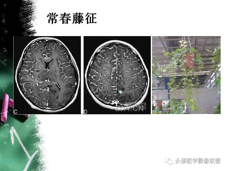 影像PPT - 【PPT】影像异常征象—神经科常见影像征象-17