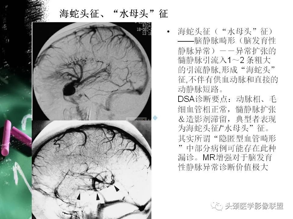 影像PPT - 【PPT】影像异常征象—神经科常见影像征象-18