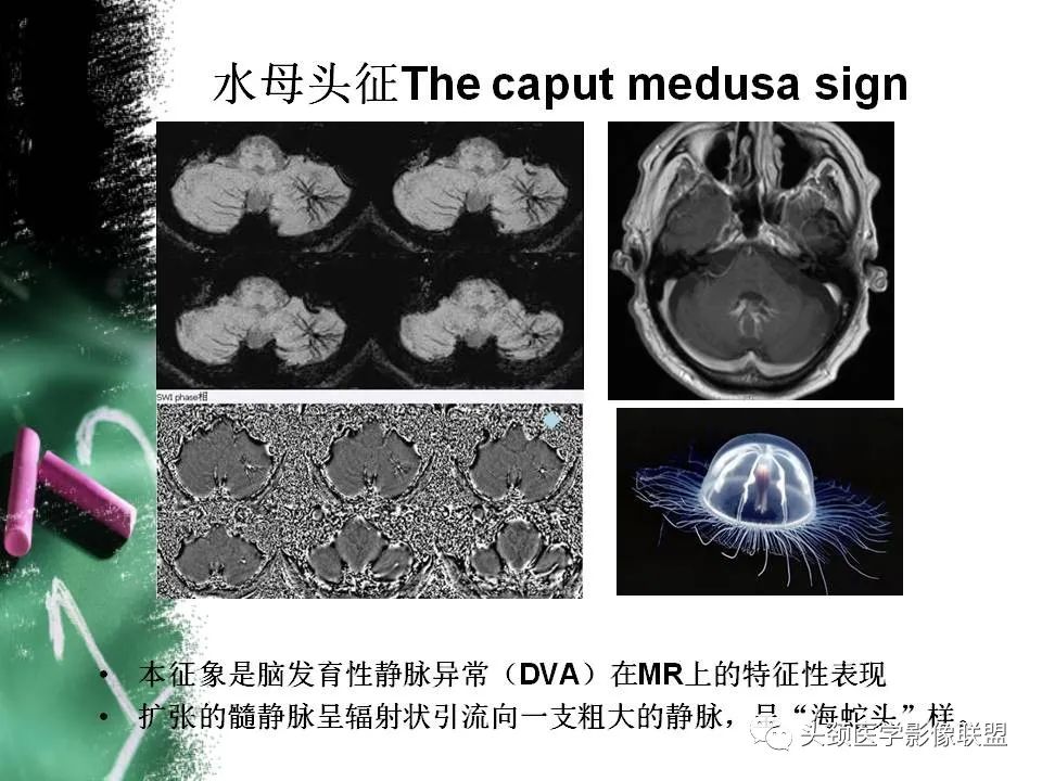 影像PPT - 【PPT】影像异常征象—神经科常见影像征象-19