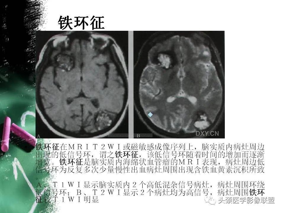 影像PPT - 【PPT】影像异常征象—神经科常见影像征象-14
