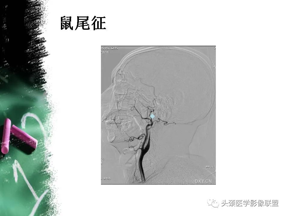 影像PPT - 【PPT】影像异常征象—神经科常见影像征象-20