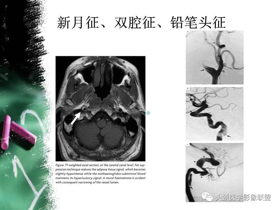 影像PPT - 【PPT】影像异常征象—神经科常见影像征象-21