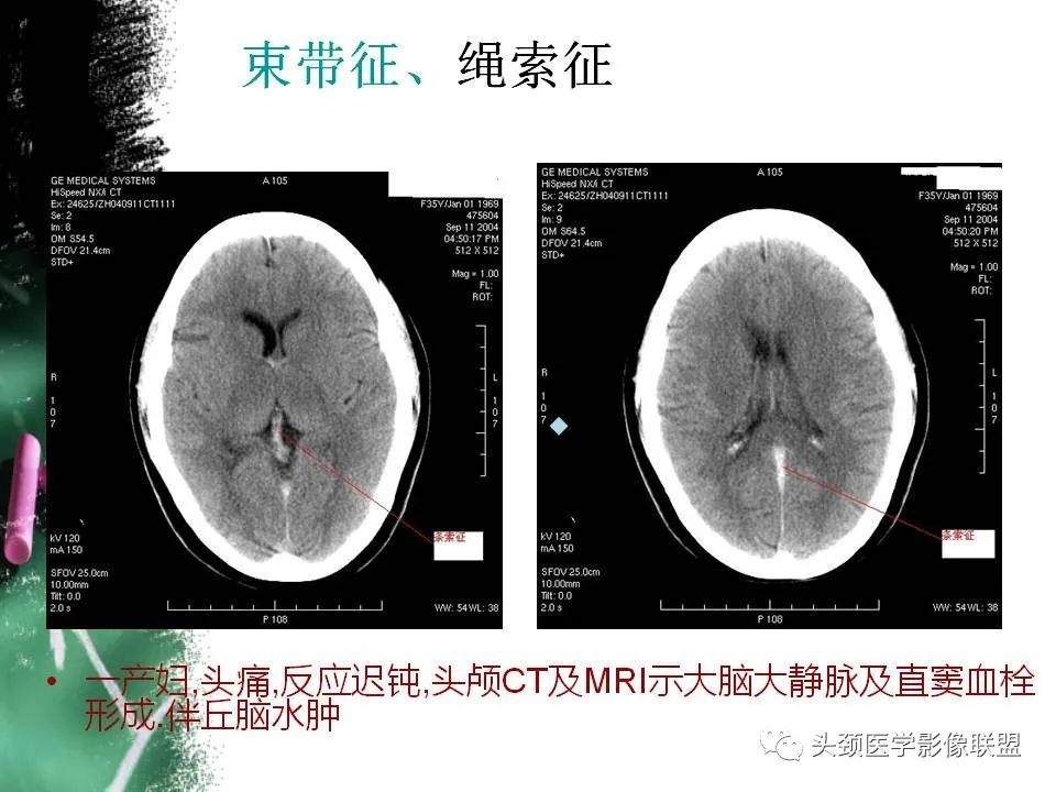 影像PPT - 【PPT】影像异常征象—神经科常见影像征象-22
