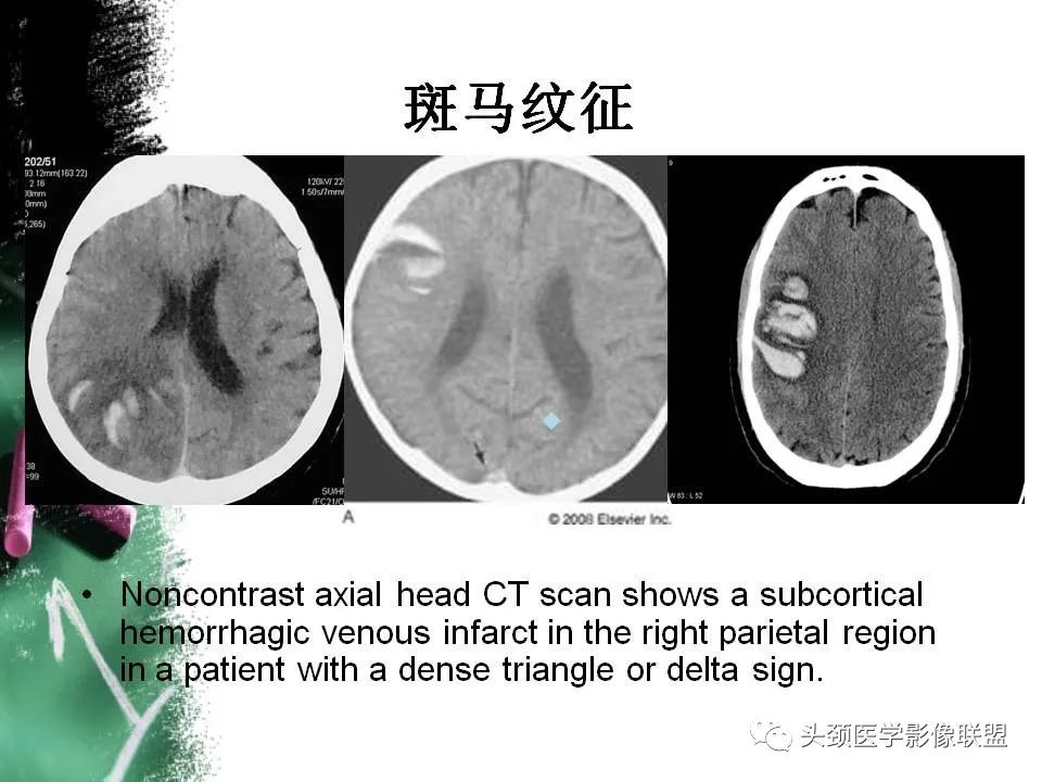 影像PPT - 【PPT】影像异常征象—神经科常见影像征象-24