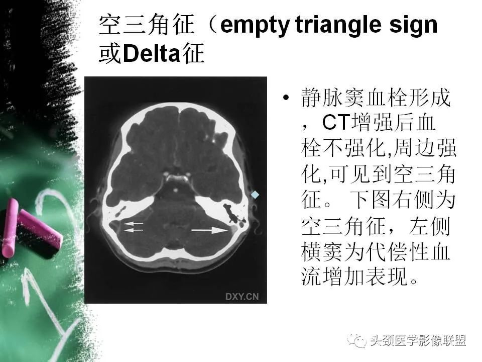 影像PPT - 【PPT】影像异常征象—神经科常见影像征象-23