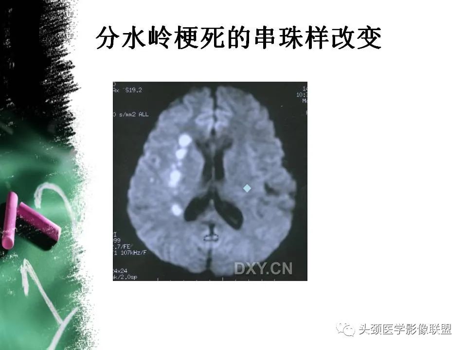 影像PPT - 【PPT】影像异常征象—神经科常见影像征象-25