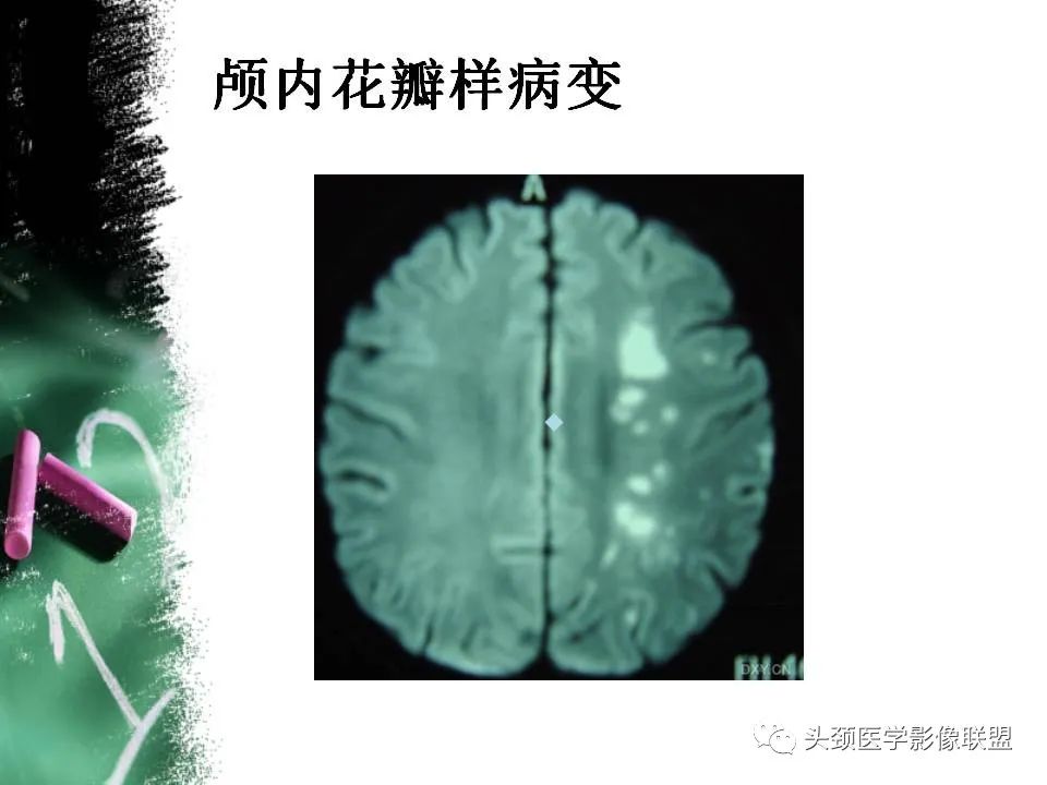 影像PPT - 【PPT】影像异常征象—神经科常见影像征象-26