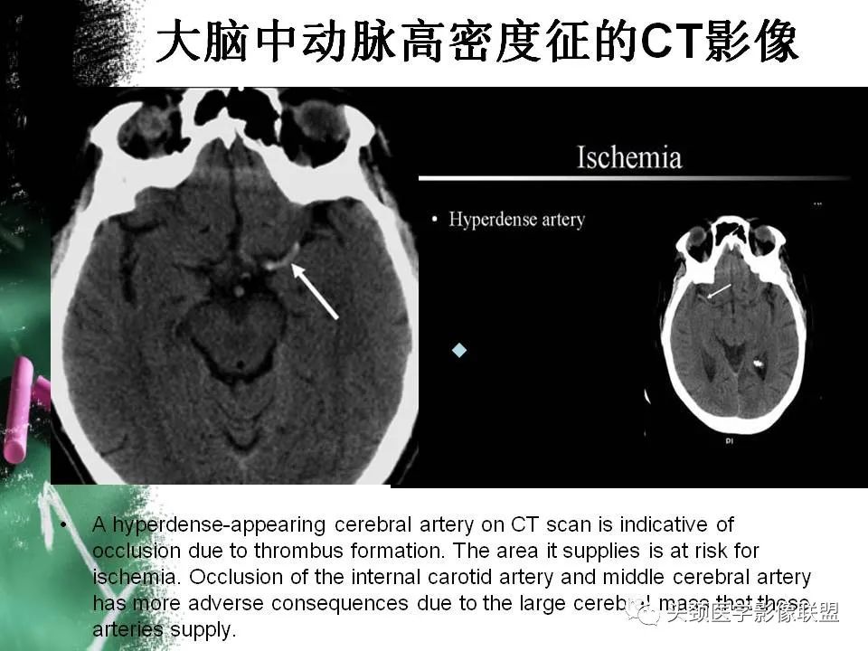 影像PPT - 【PPT】影像异常征象—神经科常见影像征象-27
