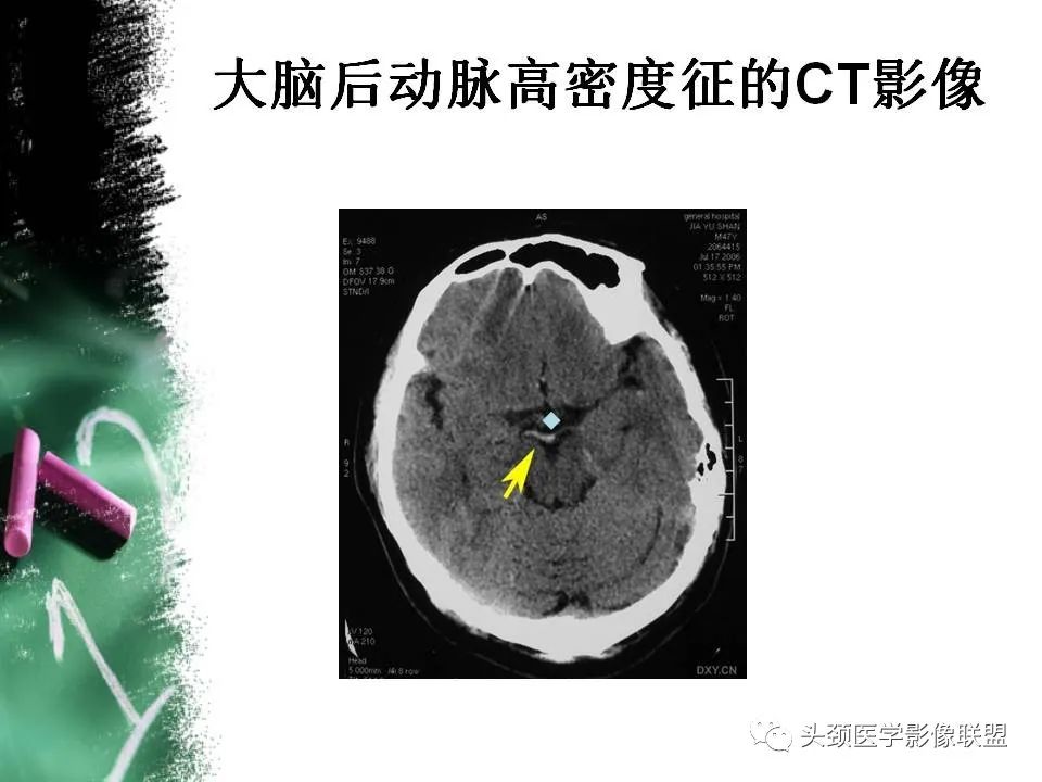 影像PPT - 【PPT】影像异常征象—神经科常见影像征象-28