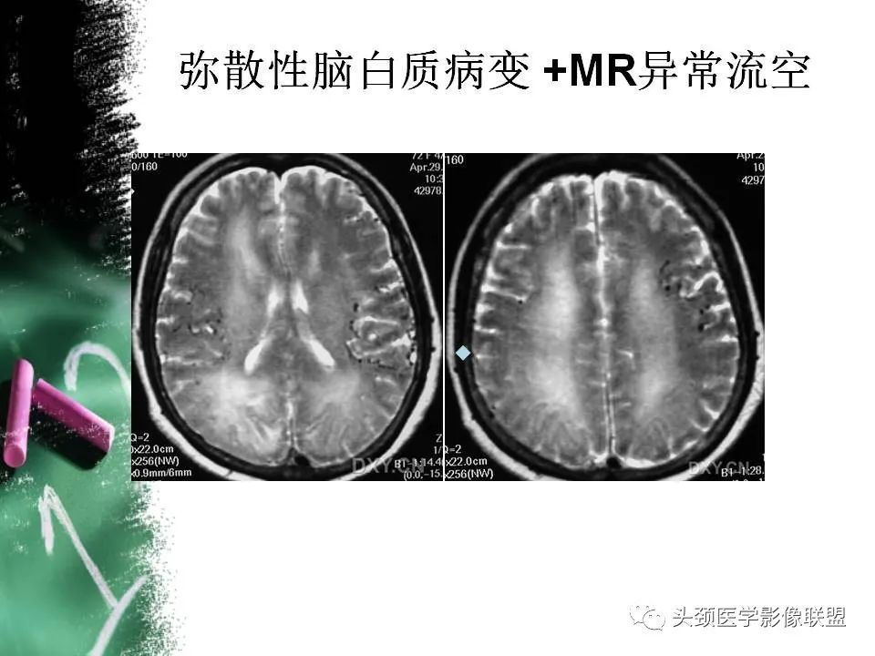 影像PPT - 【PPT】影像异常征象—神经科常见影像征象-31