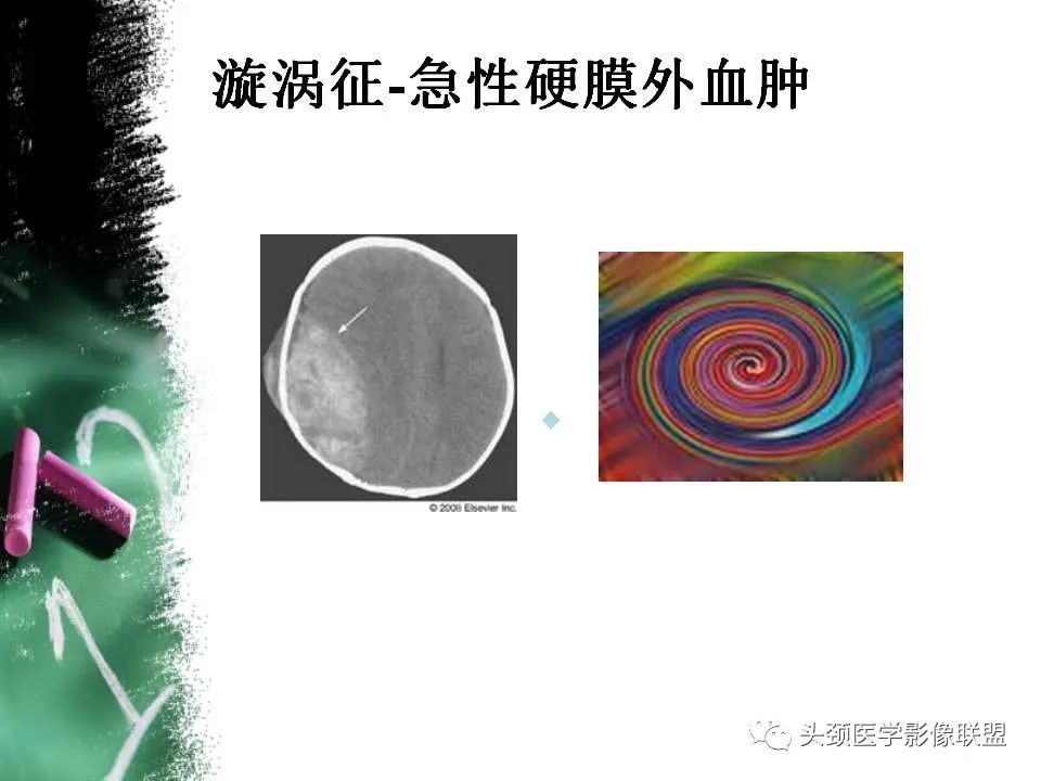 影像PPT - 【PPT】影像异常征象—神经科常见影像征象-32