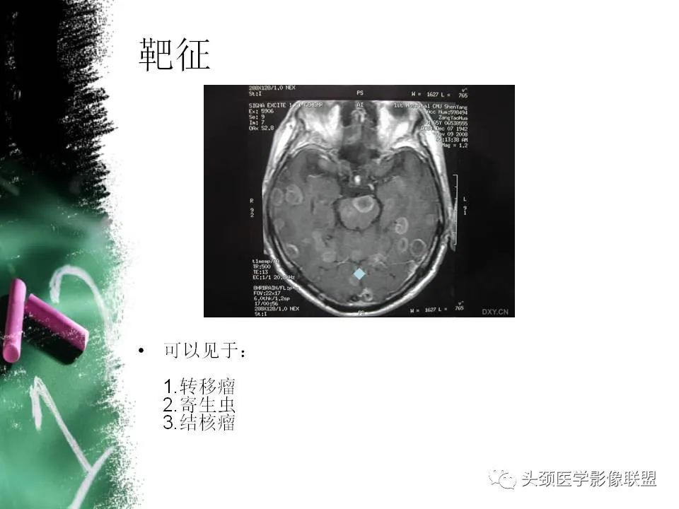 影像PPT - 【PPT】影像异常征象—神经科常见影像征象-33