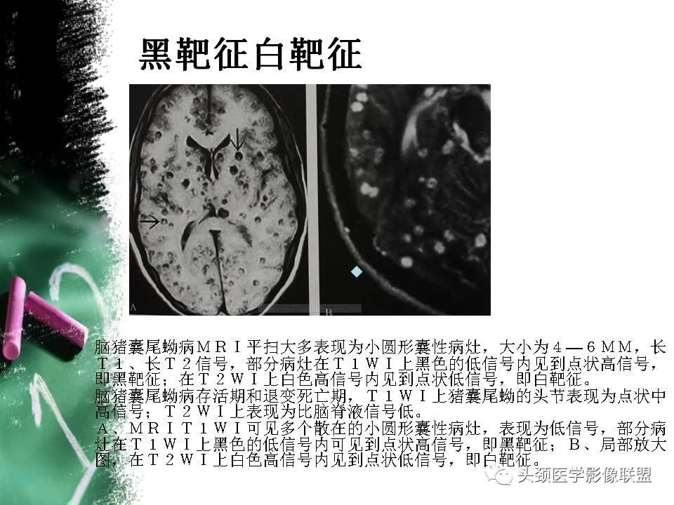 影像PPT - 【PPT】影像异常征象—神经科常见影像征象-34
