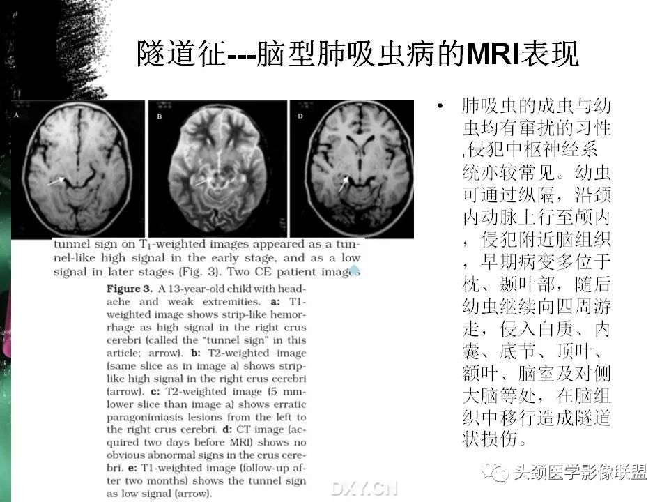 影像PPT - 【PPT】影像异常征象—神经科常见影像征象-35