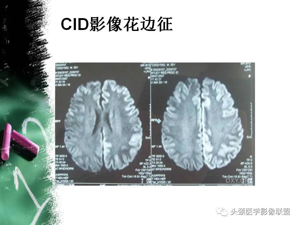 影像PPT - 【PPT】影像异常征象—神经科常见影像征象-36