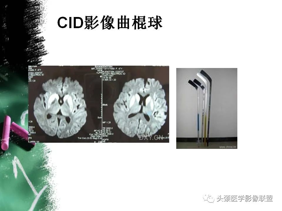 影像PPT - 【PPT】影像异常征象—神经科常见影像征象-37