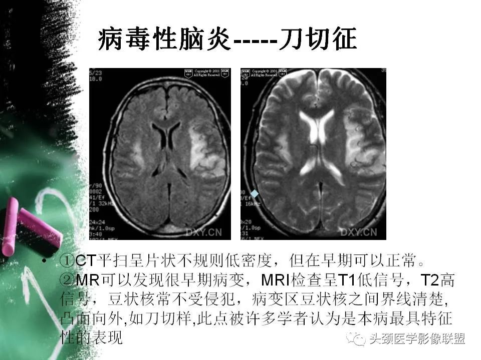影像PPT - 【PPT】影像异常征象—神经科常见影像征象-39