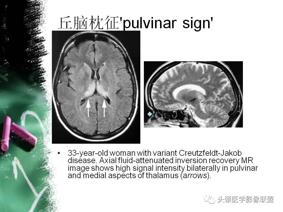 影像PPT - 【PPT】影像异常征象—神经科常见影像征象-38