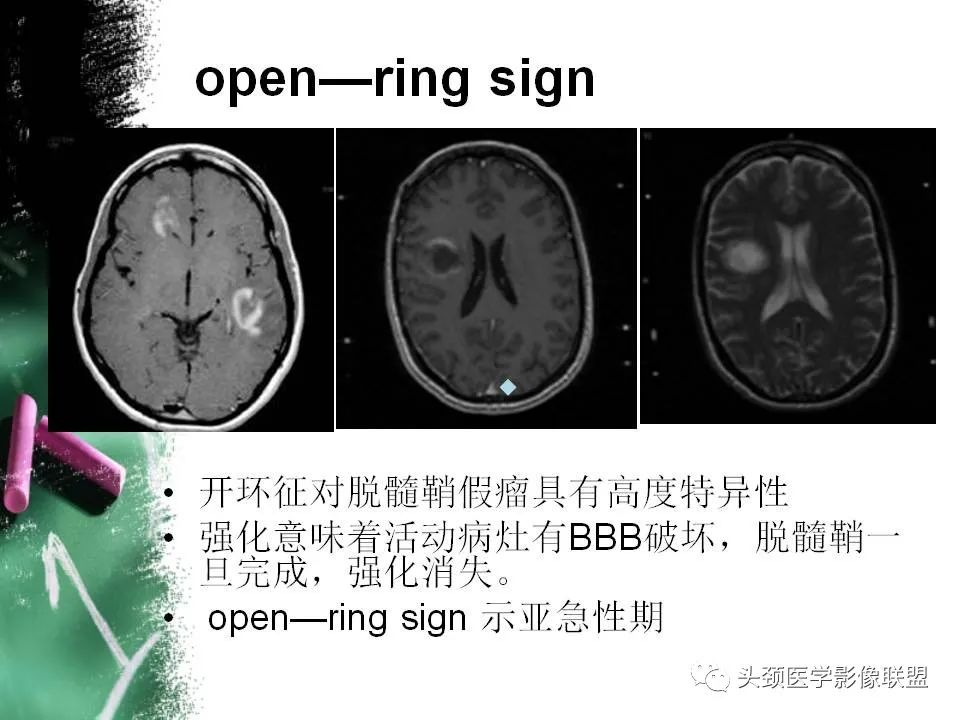 影像PPT - 【PPT】影像异常征象—神经科常见影像征象-41