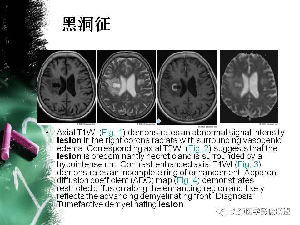 影像PPT - 【PPT】影像异常征象—神经科常见影像征象-43