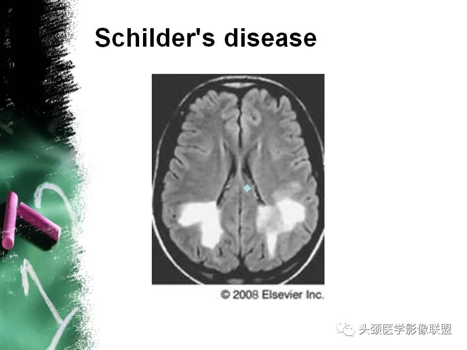 影像PPT - 【PPT】影像异常征象—神经科常见影像征象-45