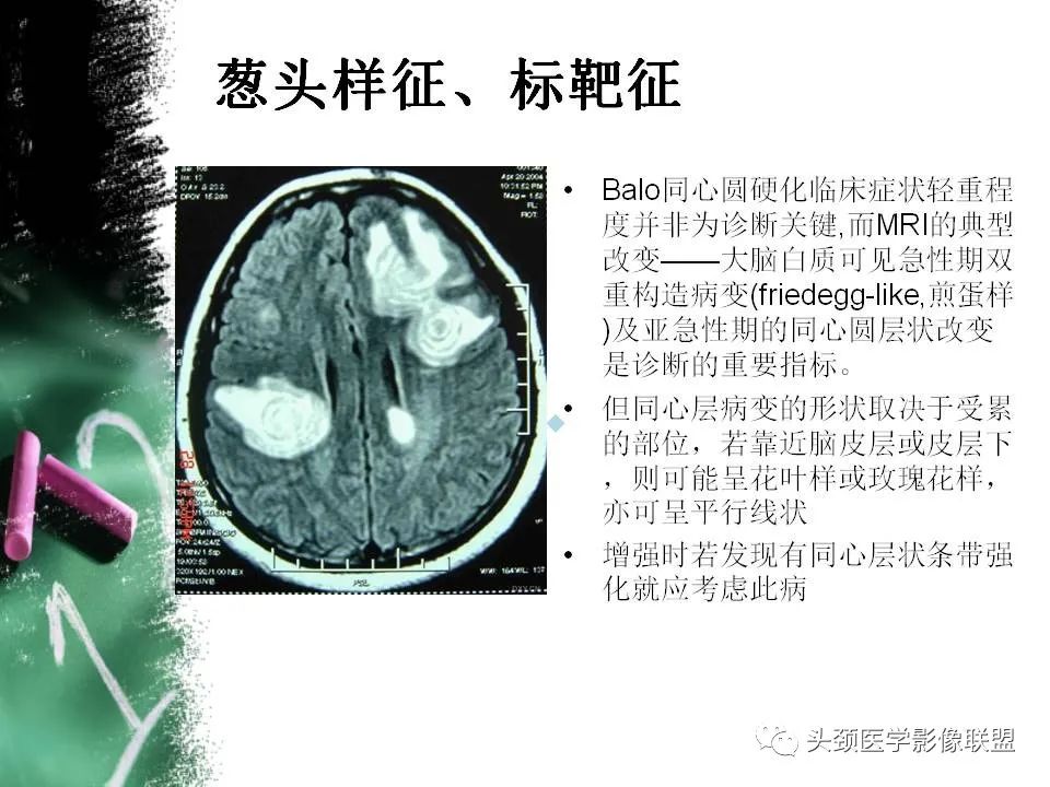 影像PPT - 【PPT】影像异常征象—神经科常见影像征象-46