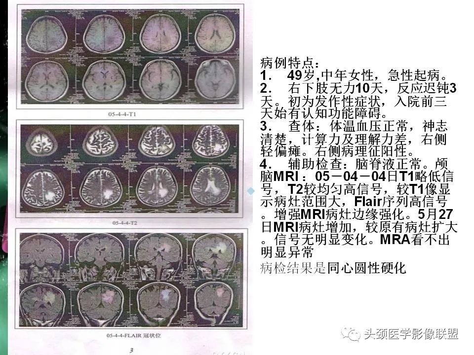 影像PPT - 【PPT】影像异常征象—神经科常见影像征象-47