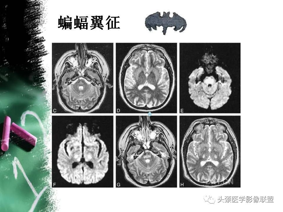 影像PPT - 【PPT】影像异常征象—神经科常见影像征象-48