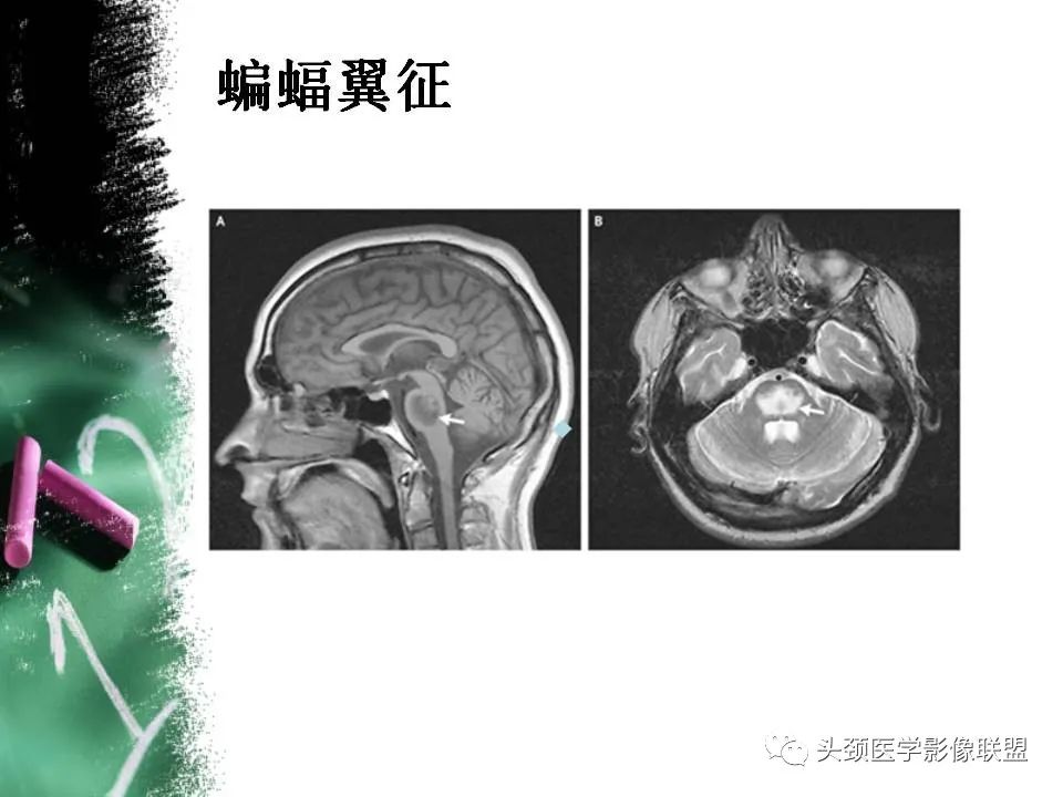 影像PPT - 【PPT】影像异常征象—神经科常见影像征象-49