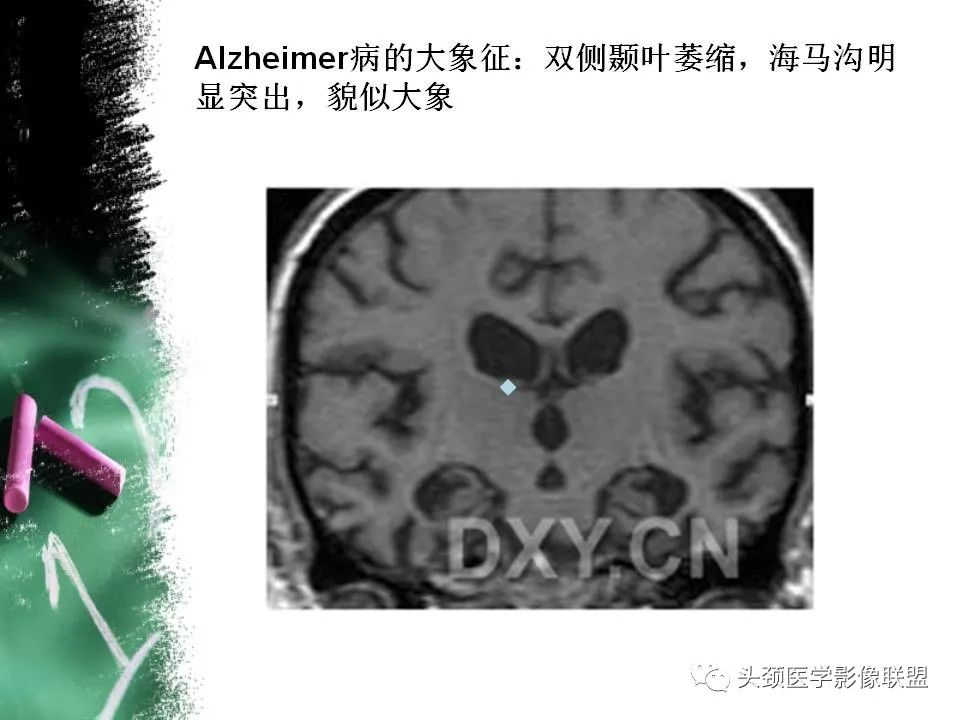 影像PPT - 【PPT】影像异常征象—神经科常见影像征象-50