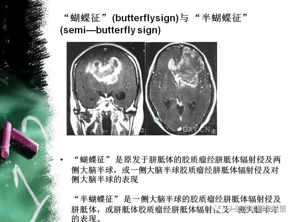 影像PPT - 【PPT】影像异常征象—神经科常见影像征象-51