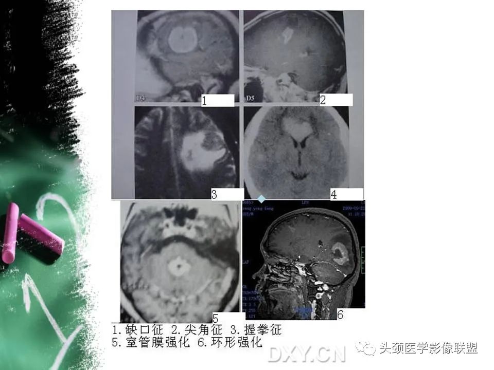 影像PPT - 【PPT】影像异常征象—神经科常见影像征象-52