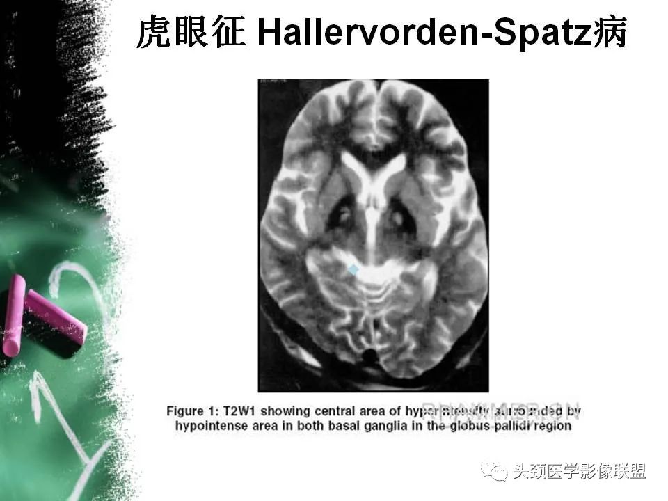 影像PPT - 【PPT】影像异常征象—神经科常见影像征象-53