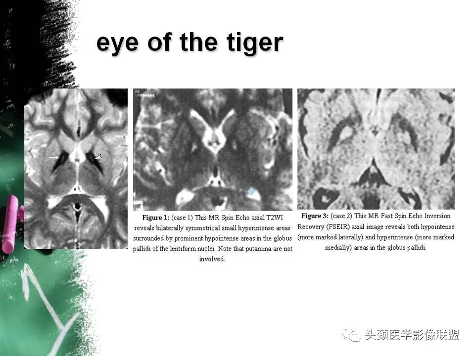 影像PPT - 【PPT】影像异常征象—神经科常见影像征象-54