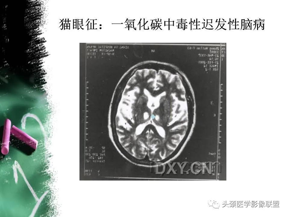 影像PPT - 【PPT】影像异常征象—神经科常见影像征象-55