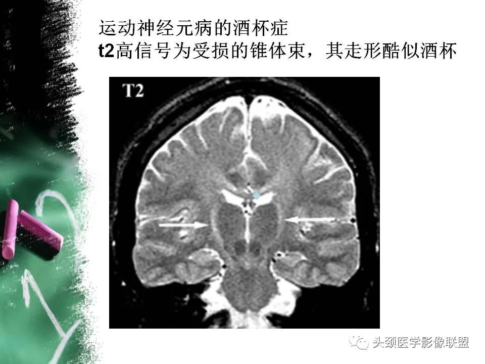 影像PPT - 【PPT】影像异常征象—神经科常见影像征象-56