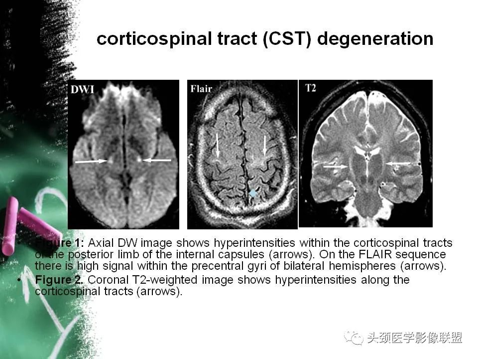 影像PPT - 【PPT】影像异常征象—神经科常见影像征象-57
