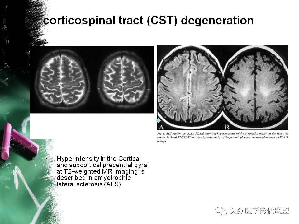影像PPT - 【PPT】影像异常征象—神经科常见影像征象-58