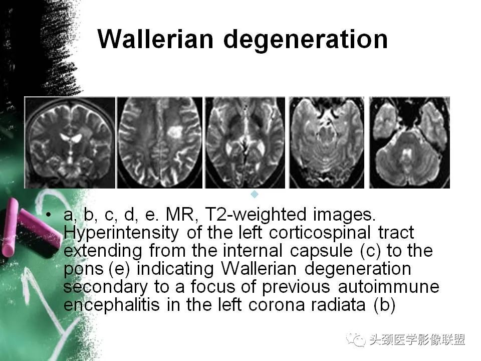 影像PPT - 【PPT】影像异常征象—神经科常见影像征象-63