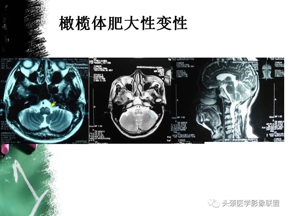 影像PPT - 【PPT】影像异常征象—神经科常见影像征象-64