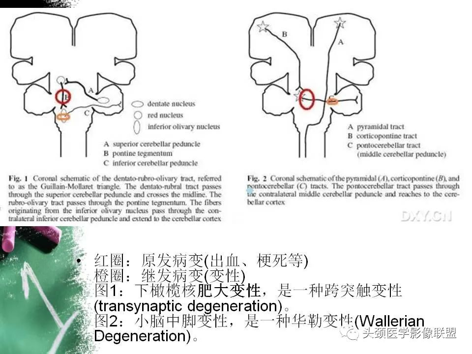 影像PPT - 【PPT】影像异常征象—神经科常见影像征象-65