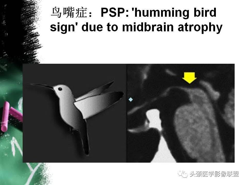 影像PPT - 【PPT】影像异常征象—神经科常见影像征象-66