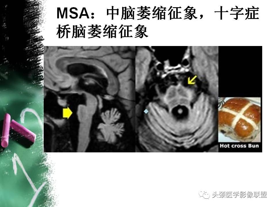影像PPT - 【PPT】影像异常征象—神经科常见影像征象-67