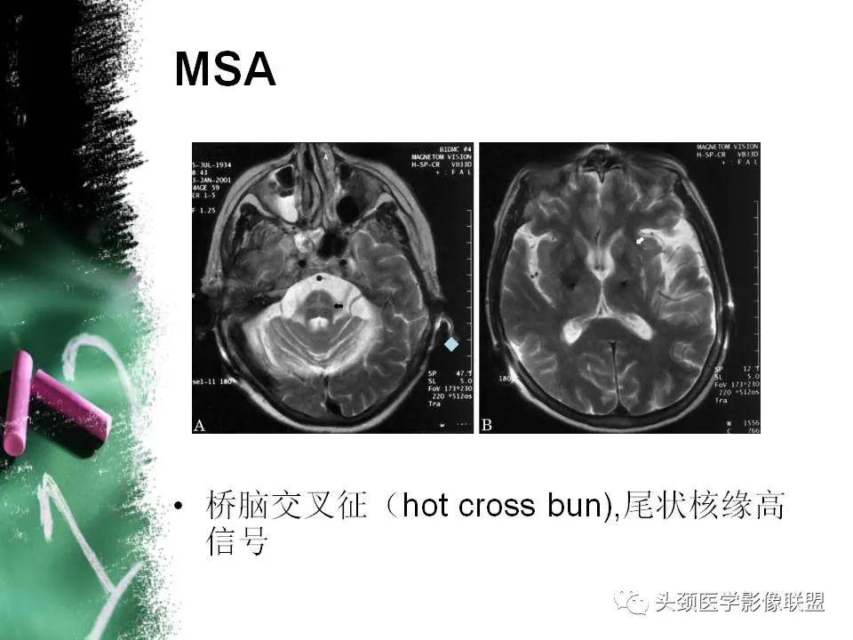 影像PPT - 【PPT】影像异常征象—神经科常见影像征象-68