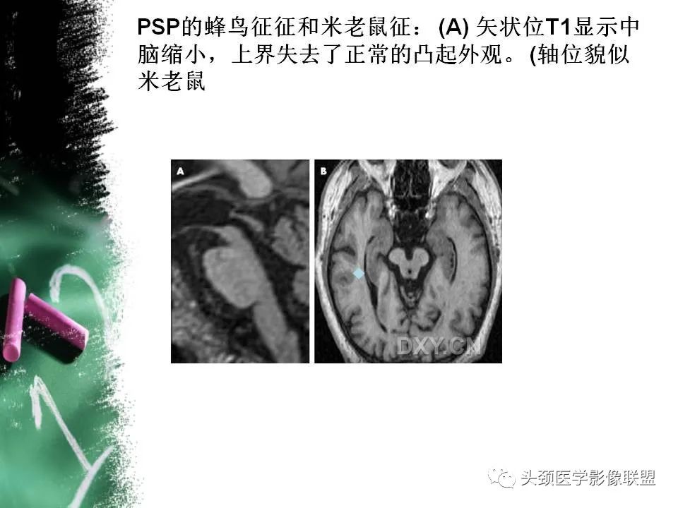 影像PPT - 【PPT】影像异常征象—神经科常见影像征象-69