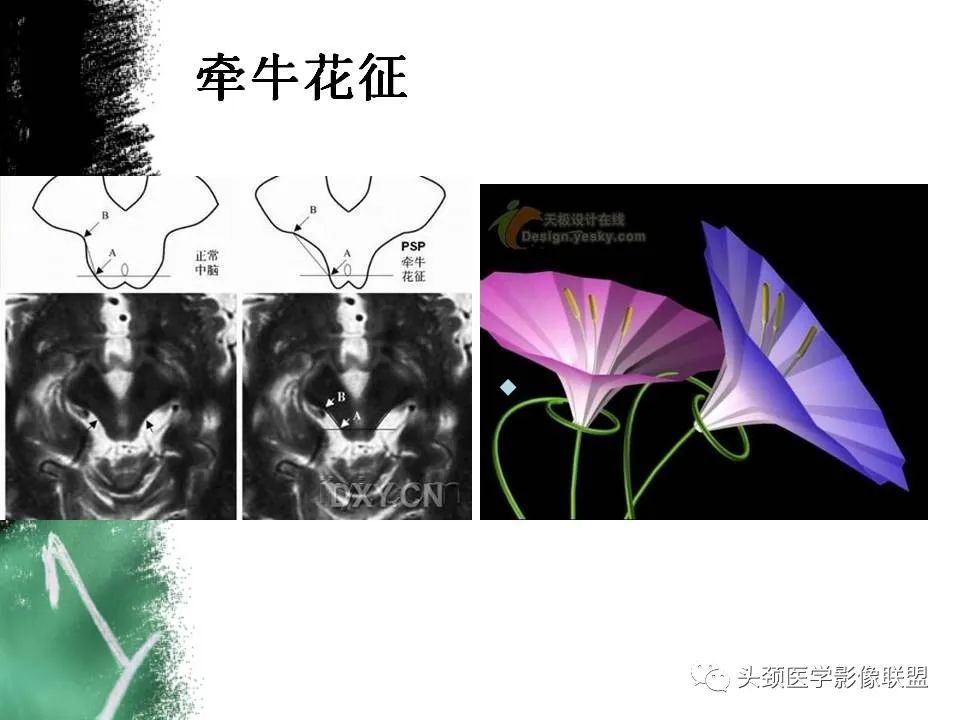 影像PPT - 【PPT】影像异常征象—神经科常见影像征象-70
