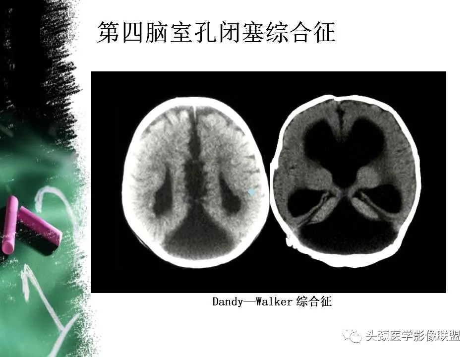 影像PPT - 【PPT】影像异常征象—神经科常见影像征象-71