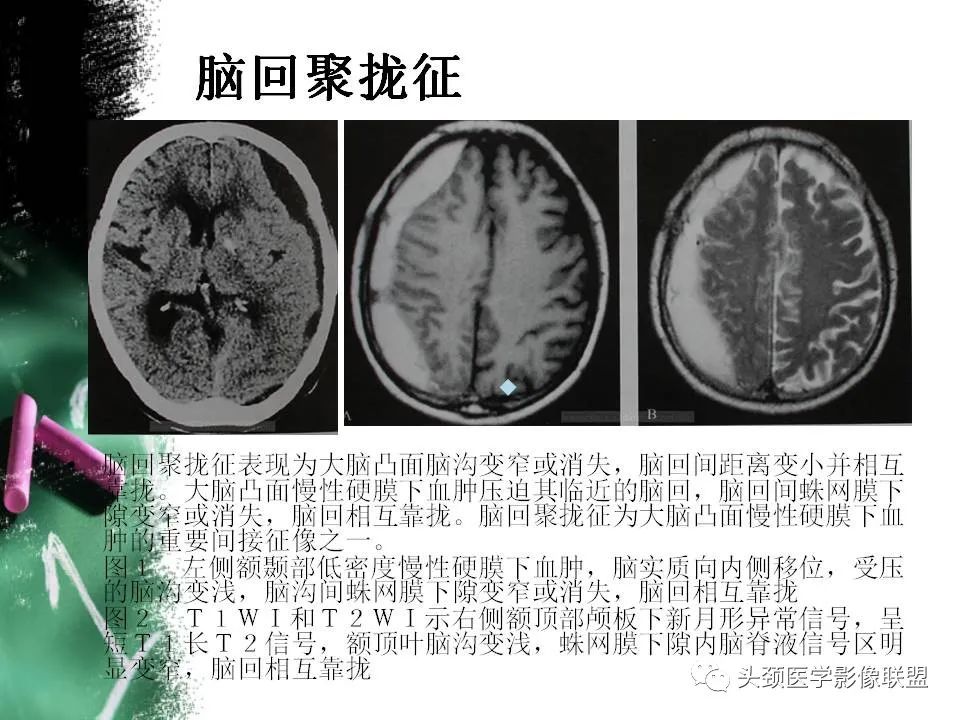 影像PPT - 【PPT】影像异常征象—神经科常见影像征象-72